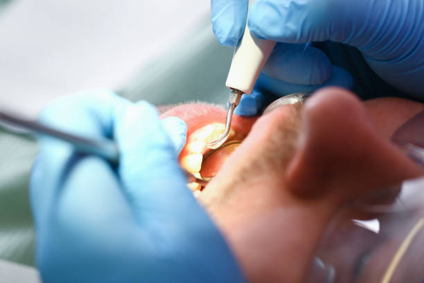 Best Emergency Dental Care for Broken or Chipped Teeth in Greenville, VA